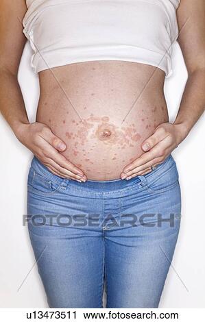 Stock Image - Pregnant woman with rash on tummy. Fotosearch