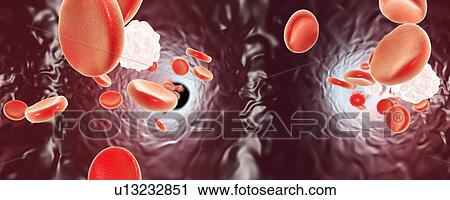 Red blood cells, illustration View Large Photo Image Stock Image - Red blood cells, illustration. Fotosearch