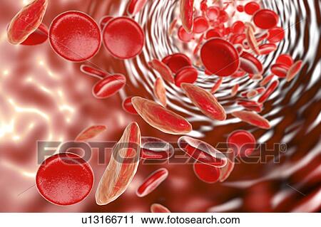 Sickle cell anaemia, illustration View Large Photo Image Stock Image - Sickle cell anaemia, illustration. Fotosearch