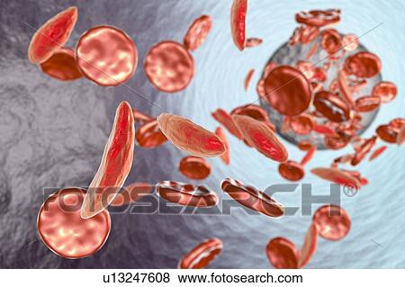 Sickle cell anaemia, illustration View Large Photo Image Stock Photo - Sickle cell anaemia, illustration. Fotosearch