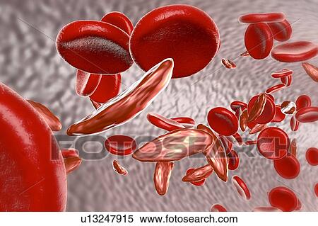 Sickle cell anaemia, illustration View Large Photo Image Stock Photography - Sickle cell anaemia, illustration. Fotosearch