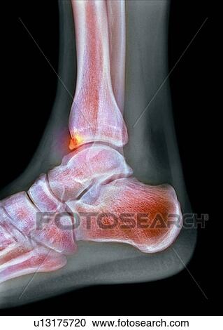 Tibial spur, X-ray View Large Photo Image Stock Image - Tibial spur, X-ray. Fotosearch