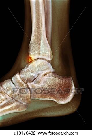 Stock Image - Tibial spur, X-ray. Fotosearch