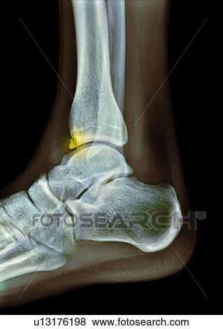 Tibial spur, X-ray View Large Photo Image Stock Photo - Tibial spur, X-ray. Fotosearch