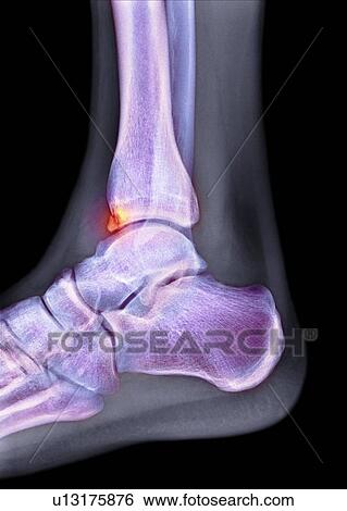 Tibial spur, X-ray View Large Photo Image Stock Photograph - Tibial spur, X-ray. Fotosearch