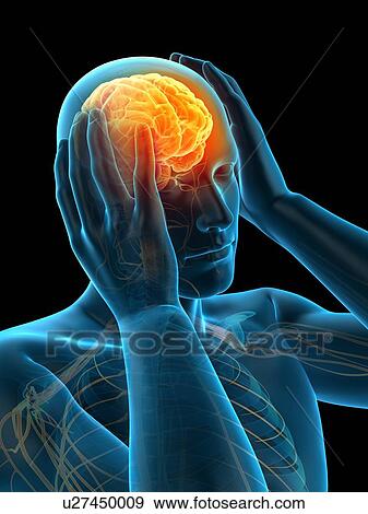 Stock Photo - Anatomy of person with headache, illustration. Fotosearch
