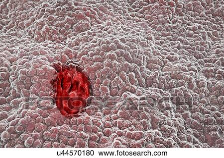 Gastric ulcer, illustration View Large Photo Image Stock Image - Gastric ulcer, illustration. Fotosearch