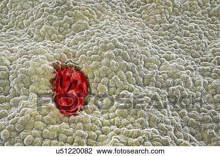 Stock Image - Gastric ulcer, illustration. Fotosearch