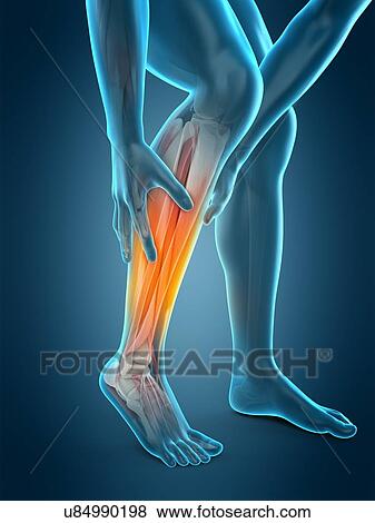 Stock Photo - Human calf pain, illustration. Fotosearch