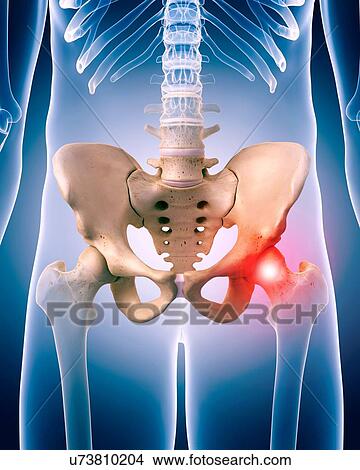 Human hip pain, illustration View Large Photo Image Picture - Human hip pain, illustration. Fotosearch