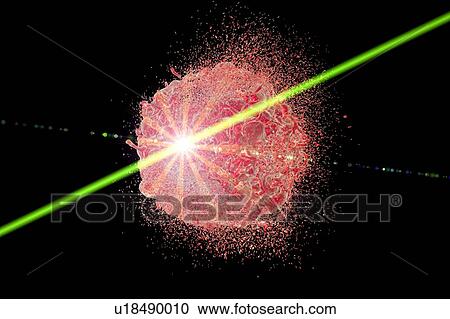 Stock Image - Laser treatment of tumor, illustration. Fotosearch