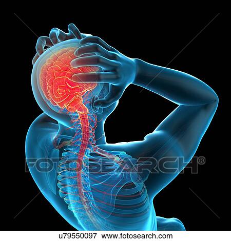 Stock Photo - Person with headache, illustration. Fotosearch