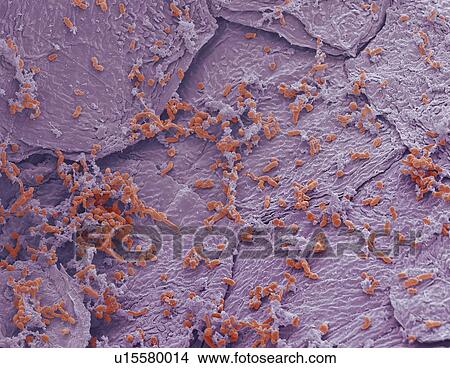 Picture - Bacterial skin infection, SEM. Fotosearch