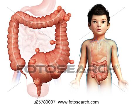Child with megacolon and diverticulosis, illustration View Large Photo Image Stock Photo - Child with megacolon and diverticulosis, illustration. Fotosearch