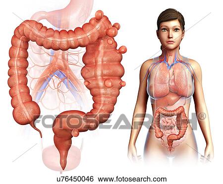 Stock Photograph - Diverticulosis and megacolon, illustration. Fotosearch