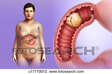 Female intestinal cancer, illustration View Large Photo Image Stock Image - Female intestinal cancer, illustration. Fotosearch
