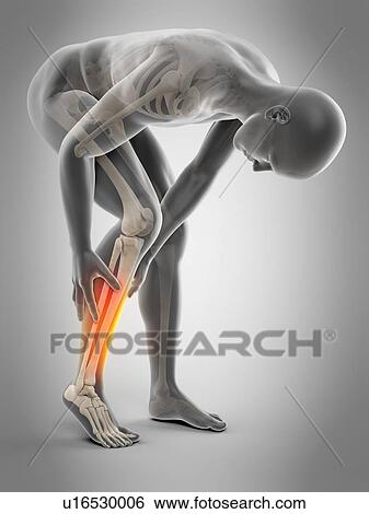 Stock Photograph - Human calf pain, illustration. Fotosearch