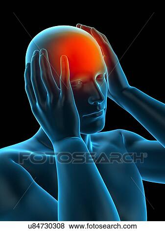 Stock Photo - Person with headache, illustration. Fotosearch