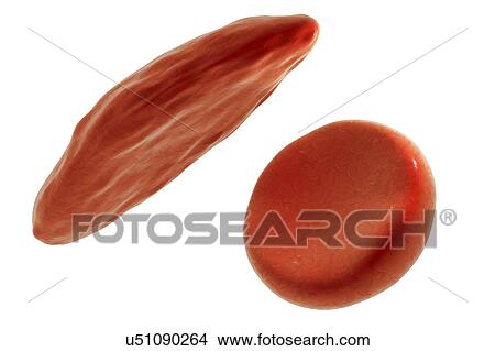 Picture - Sickle cell red blood cells, illustration. Fotosearch