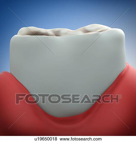Stock Photo - Gum disease, illustration. Fotosearch
