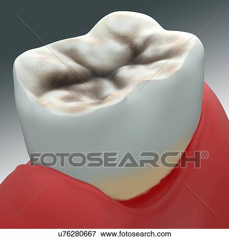 Stock Photo - Gum disease. Fotosearch