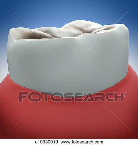Molar tooth decay, illustration View Large Photo Image Stock Photo - Molar tooth decay, illustration. Fotosearch