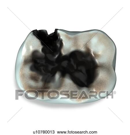Stock Image - Molar tooth decay. Fotosearch