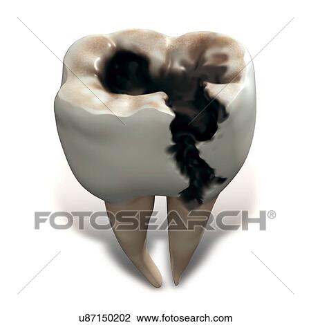 Stock Image - Molar tooth decay. Fotosearch