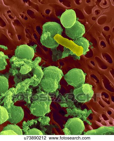 Bacteria on an epithelial cell from the human tongue filiform papilla, coloured scanning electron micrograph (SEM). Coccoid bacteria (likely Streptococcus mutans due to the fibrous glucan matrix that surrounds the cells) and one rod bacterium are seen... View Large Photo Image Stock Image - Bacteria on an epithelial cell from the human tongue filiform papilla, coloured scanning electron micrograph (SEM). Coccoid bacteria (likely Streptococcus mutans due to the fibrous glucan matrix that surrounds the cells) and one rod bacterium are seen.... Fotosearch