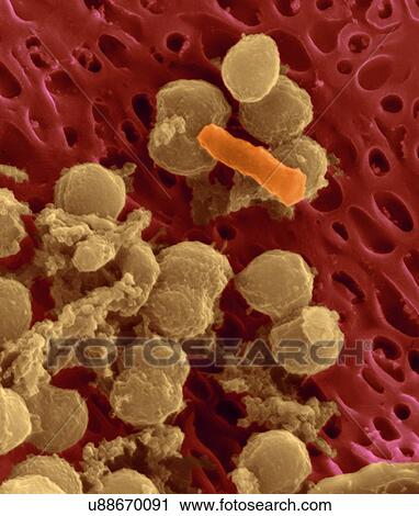 Bacteria on an epithelial cell from the human tongue filiform papilla, coloured scanning electron micrograph (SEM). Coccoid bacteria (likely Streptococcus mutans due to the fibrous glucan matrix that surrounds the cells) and one rod bacterium are seen... View Large Photo Image Stock Image - Bacteria on an epithelial cell from the human tongue filiform papilla, coloured scanning electron micrograph (SEM). Coccoid bacteria (likely Streptococcus mutans due to the fibrous glucan matrix that surrounds the cells) and one rod bacterium are seen.... Fotosearch