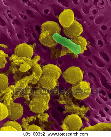 Stock Image - Bacteria on an epithelial cell from the human tongue filiform papilla, coloured scanning electron micrograph (SEM). Coccoid bacteria (likely Streptococcus mutans due to the fibrous glucan matrix that surrounds the cells) and one rod bacterium are seen.... Fotosearch