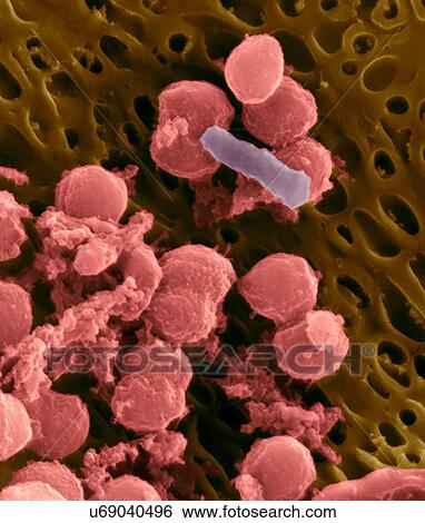 Stock Photograph - Bacteria on an epithelial cell from the human tongue filiform papilla, coloured scanning electron micrograph (SEM). Coccoid bacteria (likely Streptococcus mutans due to the fibrous glucan matrix that surrounds the cells) and one rod bacterium are seen.... Fotosearch