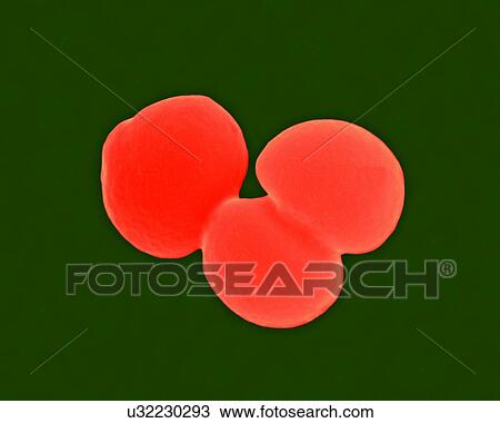 Coloured scanning electron micrograph (SEM) of Staphylococcus aureus, Gram-positive, MRSA, coccus prokaryote (dividing); causes food poisoning, toxic shock syndrome and skin and wound infections such as scalded skin syndrome, scarlet fever, erysipelas... View Large Photo Image Stock Image - Coloured scanning electron micrograph (SEM) of Staphylococcus aureus, Gram-positive, MRSA, coccus prokaryote (dividing); causes food poisoning, toxic shock syndrome and skin and wound infections such as scalded skin syndrome, scarlet fever, erysipelas.... Fotosearch