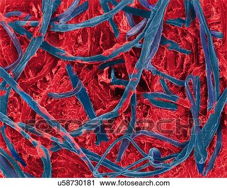 Stock Image - Cotton bud with ear wax embedded in fibres, coloured scanning electron micrograph (SEM). A cotton bud is a small stick with a cotton swab at one or both ends. It is used as a cleaning tool for ears but has many other uses including beauty, cosmetics,.... Fotosearch
