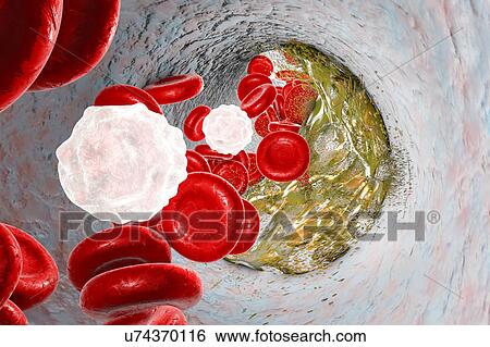 Destruction of atheromatous plaque inside blood vessel, computer illustration. A cholesterol atheroma is causing a narrowing of an artery (atherosclerosis). Conceptual image for atherosclerosis treatment. View Large Photo Image Stock Photograph - Destruction of atheromatous plaque inside blood vessel, computer illustration. A cholesterol atheroma is causing a narrowing of an artery (atherosclerosis). Conceptual image for atherosclerosis treatment.. Fotosearch