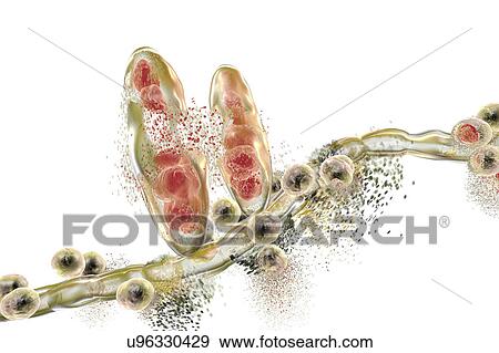 Stock Photo - Destruction of athlete's foot fungus Trichophyton mentagrophytes, computer illustration. Conceptual image for Athlete's foot treatment and prevention. T. mentagrophytes is the cause of athlete's foot (tinea pedis) and scalp ringworm (tinea capitus)..... Fotosearch