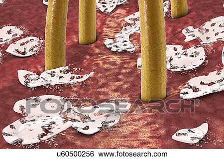 Stock Photograph - Destruction of dandruff, computer illustration. Conceptual image for dandruff treatment.. Fotosearch
