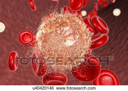 Stock Photograph - Destruction of leukaemia blood cell, computer illustration. Conceptual image for leukaemia treatment.. Fotosearch