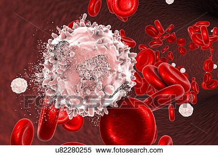 Destruction of leukaemia blood cell, computer illustration. Conceptual image for leukaemia treatment. View Large Photo Image Stock Photography - Destruction of leukaemia blood cell, computer illustration. Conceptual image for leukaemia treatment.. Fotosearch