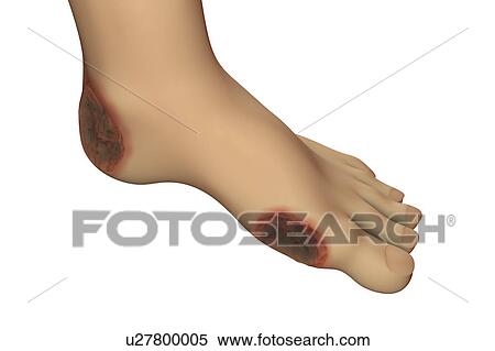 Diabetic foot ulcers. Computer illustration showing the common location of ulcers in diabetic foot infection. View Large Photo Image Stock Photography - Diabetic foot ulcers. Computer illustration showing the common location of ulcers in diabetic foot infection.. Fotosearch