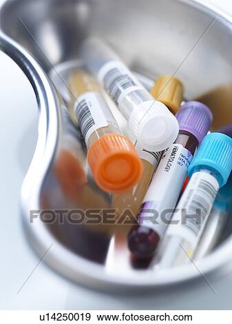 Stock Photo - Human medical samples including blood and urine in a kidney shaped bowl.. Fotosearch