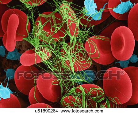 Picture - Human red blood cells and activated platelets trapped in a fibrin blood clot, coloured scanning electron micrograph (SEM). Platelets in the blood are small oval disks and are termed nonactivated platelets or thrombocytes. Platelets serve as the body's.... Fotosearch