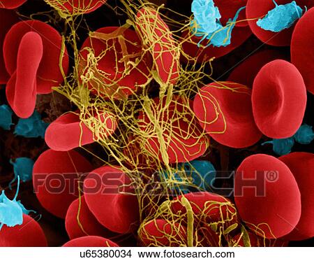 Human red blood cells and activated platelets trapped in a fibrin blood clot, coloured scanning electron micrograph (SEM). Platelets in the blood are small oval disks and are termed nonactivated platelets or thrombocytes. Platelets serve as the body's... View Large Photo Image Picture - Human red blood cells and activated platelets trapped in a fibrin blood clot, coloured scanning electron micrograph (SEM). Platelets in the blood are small oval disks and are termed nonactivated platelets or thrombocytes. Platelets serve as the body's.... Fotosearch