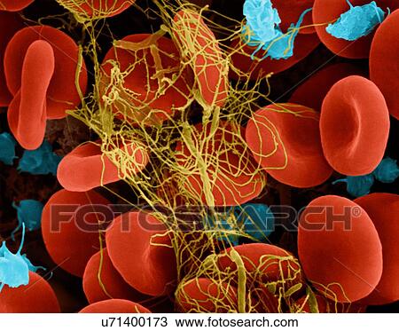 Stock Image - Human red blood cells and activated platelets trapped in a fibrin blood clot, coloured scanning electron micrograph (SEM). Platelets in the blood are small oval disks and are termed nonactivated platelets or thrombocytes. Platelets serve as the body's.... Fotosearch