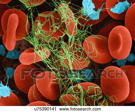 Stock Image - Human red blood cells and activated platelets trapped in a fibrin blood clot, coloured scanning electron micrograph (SEM). Platelets in the blood are small oval disks and are termed nonactivated platelets or thrombocytes. Platelets serve as the body's.... Fotosearch