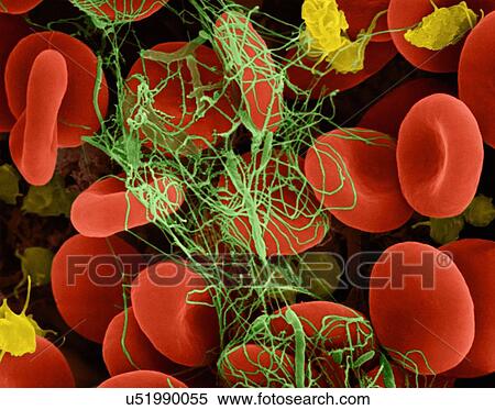 Stock Photography - Human red blood cells and activated platelets trapped in a fibrin blood clot, coloured scanning electron micrograph (SEM). Platelets in the blood are small oval disks and are termed nonactivated platelets or thrombocytes. Platelets serve as the body's.... Fotosearch