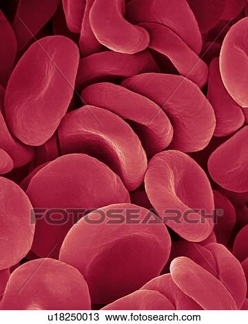 Stock Image - Human red blood cells, coloured scanning electron micrograph (SEM). Red blood cells (RBCs), or erythrocytes, are the most common type of blood cell in vertebrates. They are involved in delivering oxygen to the body tissue. RBCs take up oxygen in the.... Fotosearch