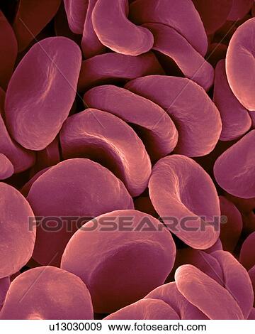 Stock Photo - Human red blood cells, coloured scanning electron micrograph (SEM). Red blood cells (RBCs), or erythrocytes, are the most common type of blood cell in vertebrates. They are involved in delivering oxygen to the body tissue. RBCs take up oxygen in the.... Fotosearch