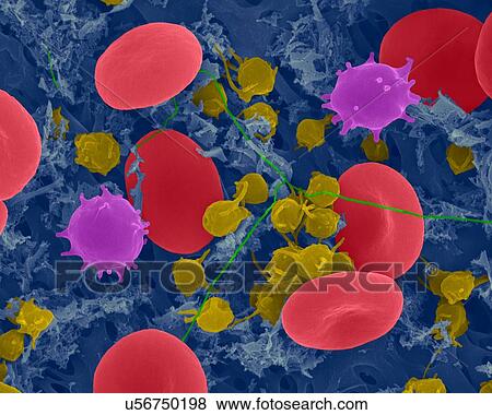Stock Photo - Human red blood cells, monocytes (white blood cells), activated platelets and fibrin, coloured scanning electron micrograph (SEM). Red blood cells (RBCs), or erythrocytes, are the most common type of blood cell in vertebrates. Red blood cells (RBCs),.... Fotosearch