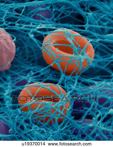Human red blood cells trapped in a fibrin blood clot, coloured scanning electron micrograph (SEM). Human red blood cells trapped in a fibrin blood clot. Platelets (not seen) are cell fragments in the blood that play an essential role in blood clotting... View Large Photo Image Picture - Human red blood cells trapped in a fibrin blood clot, coloured scanning electron micrograph (SEM). Human red blood cells trapped in a fibrin blood clot. Platelets (not seen) are cell fragments in the blood that play an essential role in blood clotting.... Fotosearch